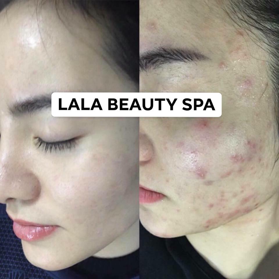 khach-hang-cua-myspa-lala-beauty-spa