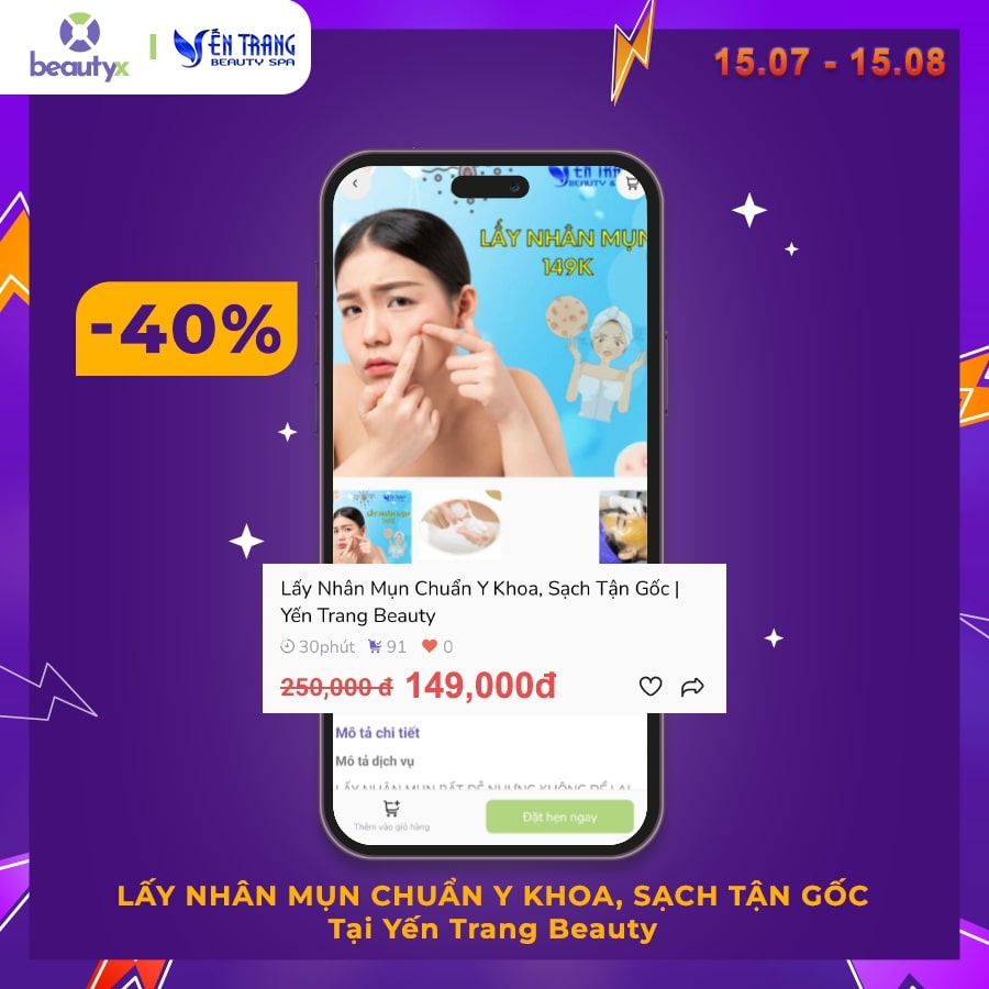 Lấy sạch nhân mụn với ưu đãi cực lớn tại Yến Trang Beauty