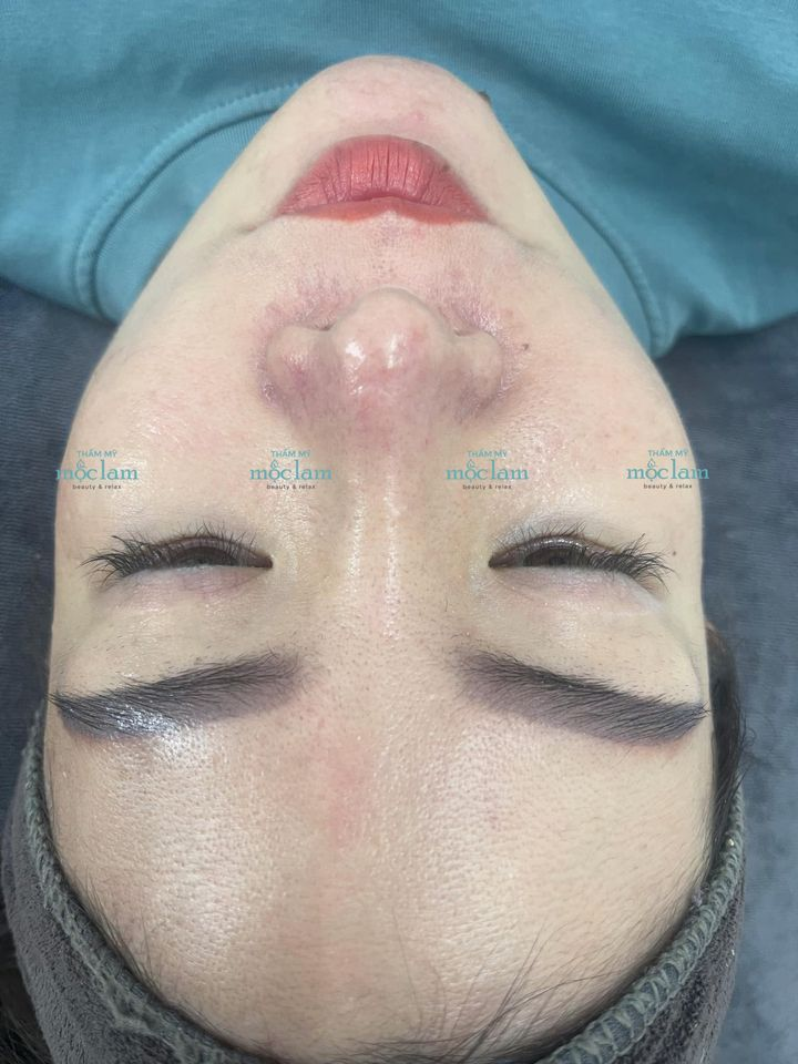 Hình ảnh thực tế khách hàng điều trị sẹo rỗ bằng phương pháp Fractional CO2 và mesotherapy tại Thẩm mỹ Mộc Lam (Nguồn: fanpage Thẩm mỹ Mộc Lam)