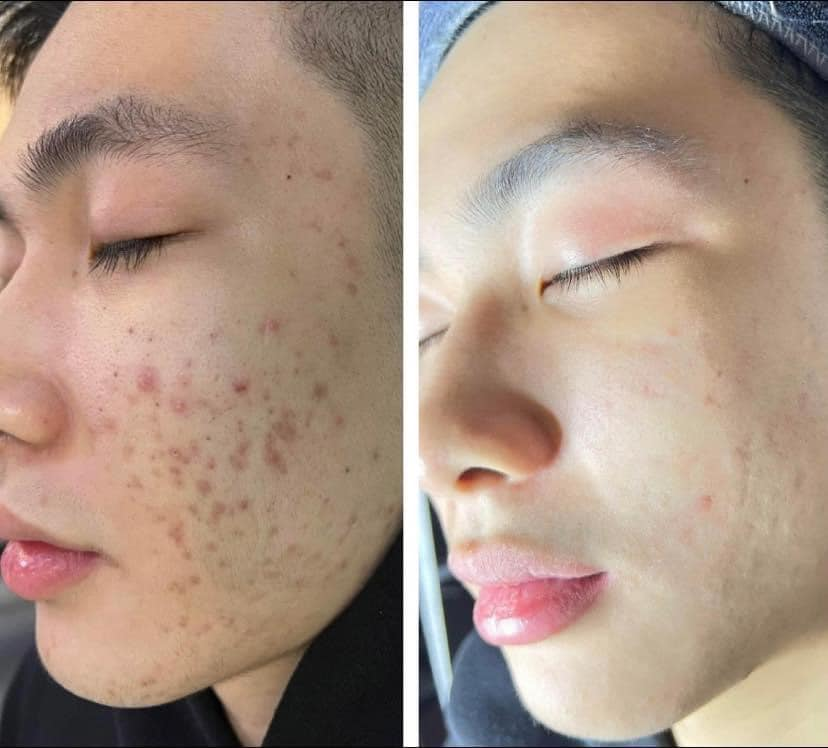 kết quả sau khi trải nghiệm dịch vụ chăm sóc da chuyên sâu tại Thu Hương Beauty & Clinic