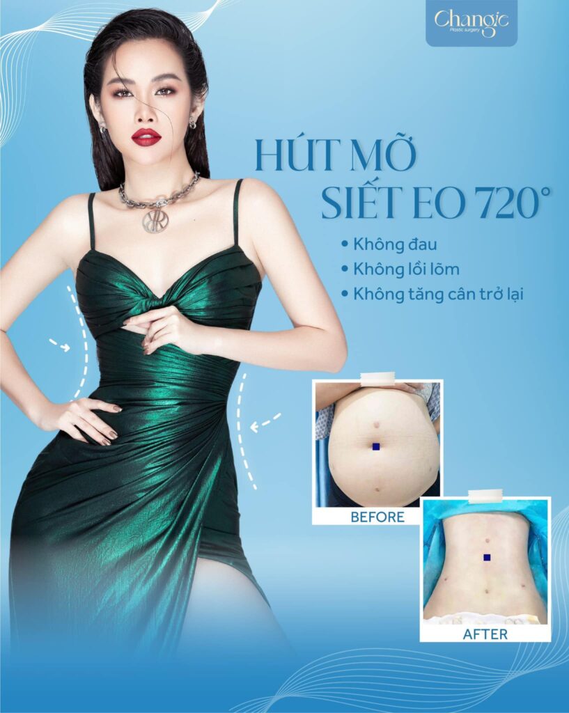 Hút Mỡ Siết Eo 720 Thẩm Mỹ Changie Hút Sạch Mỡ Thừa