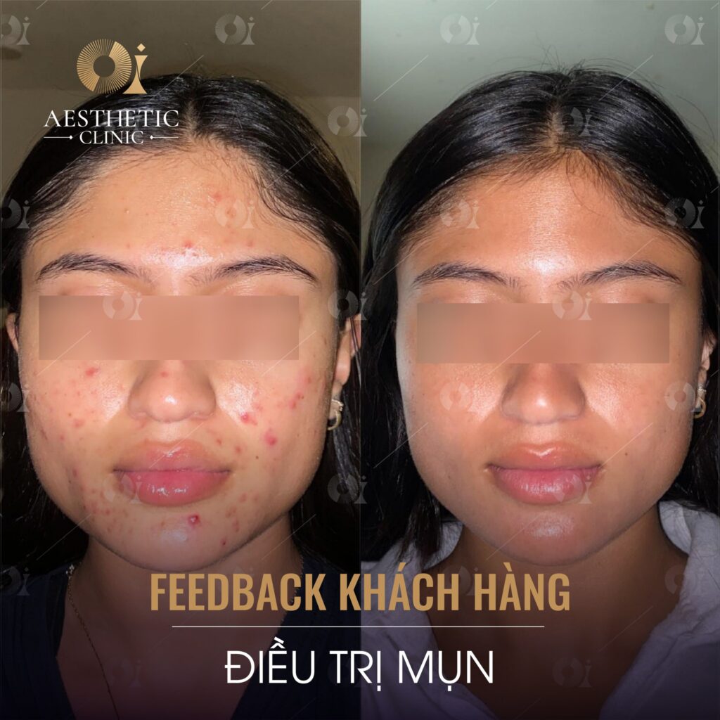 Feedback từ khách hàng điều trị mụn tại OI Aesthetic Clinic