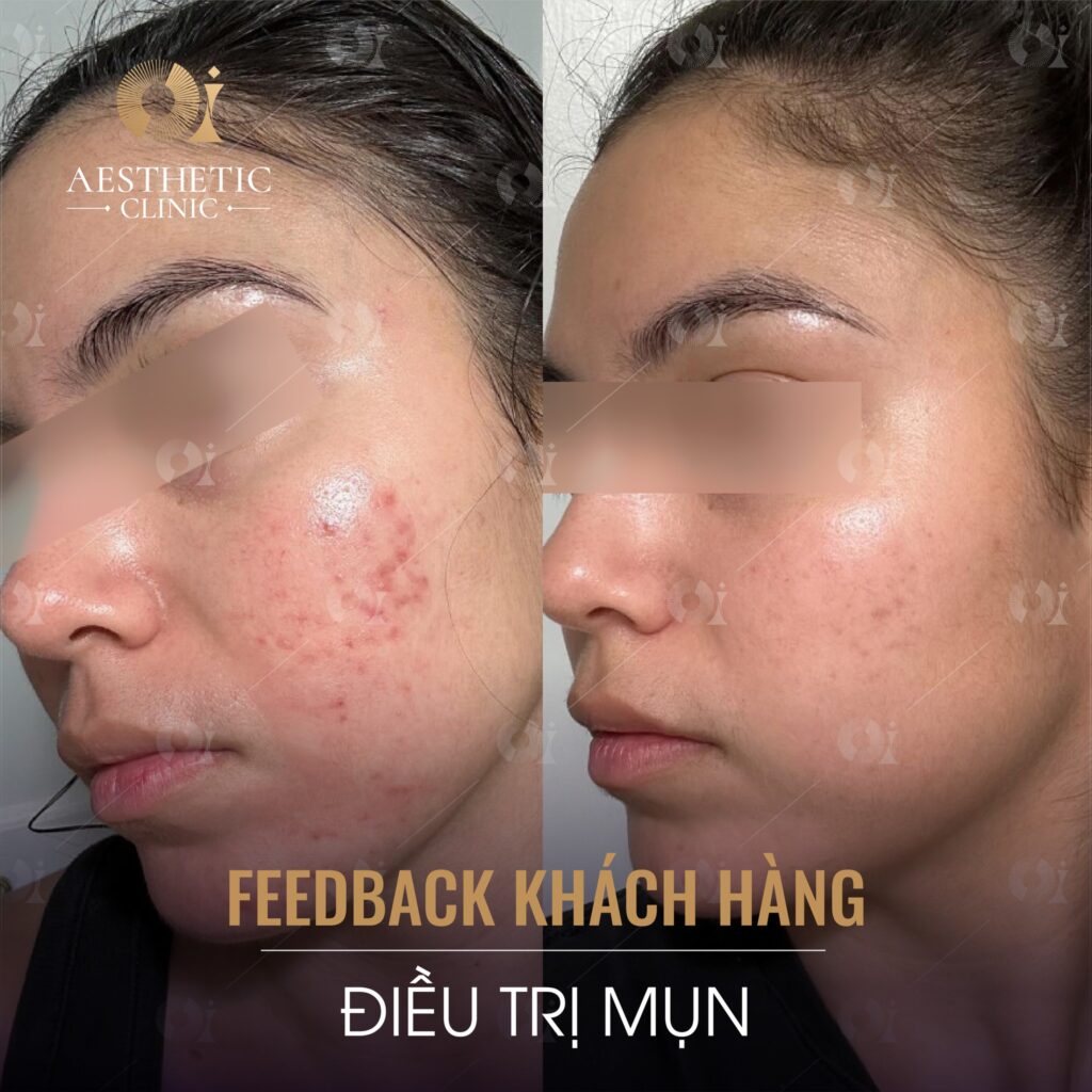 Feedback từ khách hàng điều trị mụn tại OI Aesthetic Clinic