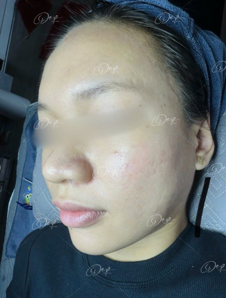 Laser Fractional CO2 xử lý triệt để sẹo rỗ nặng, lâu năm 3