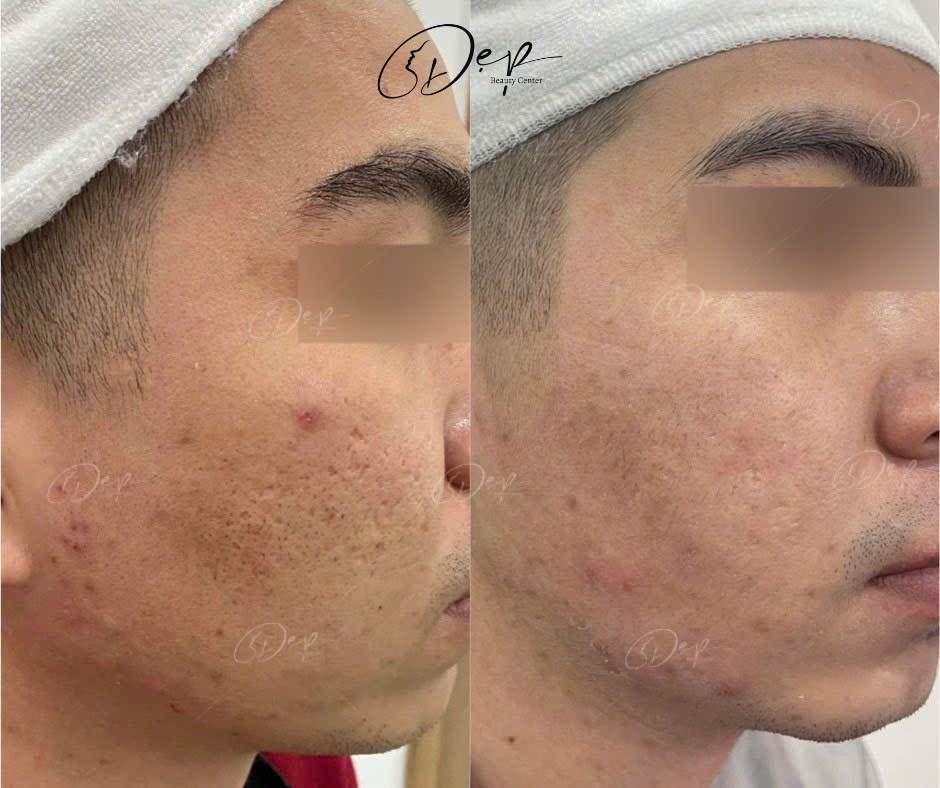 Laser Fractional CO2 xử lý triệt để sẹo rỗ nặng, lâu năm